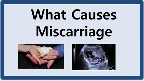 What Causes Miscarriage اسقاط حمل کی وجہ کیا ہے؟ Youtube