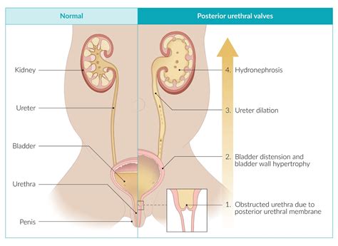 Posterior Urethral Valves Diagram