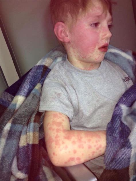 Child Complained Of Poison Oak But It Was Stevens Johnson Syndrome