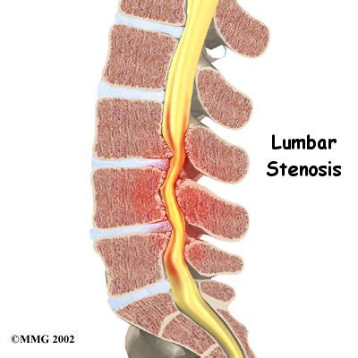 Lumbar Stenosis Narrowing Of The Spinal Canal Daily Body Impairment