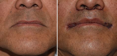 Plastic Surgery Case Study Rejuvenation Of The Male Mouth With Lip
