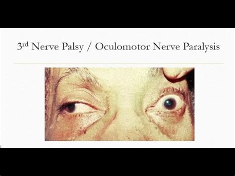 Rd Nerve Palsy Oculomotor Nerve Paralysis And Its Types Youtube