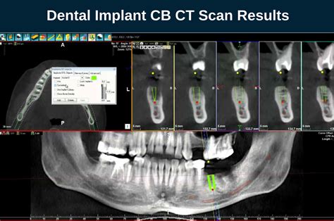 Computed Tomography (CT Scan) for Dental Implantation - Omega PDS