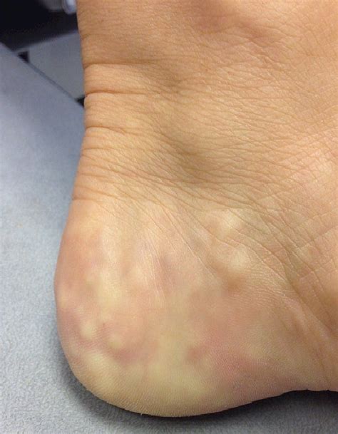 Piezogenic Papules What Are They And How Do They Form In 2024 Foot