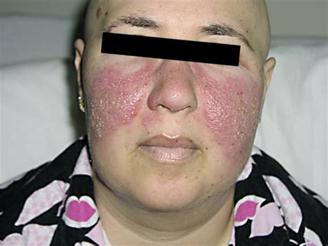 Patient With Development Of A Rash In Malar Distribution 24 H After