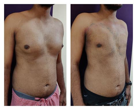 Gynaecomastia Surgery Cost In Bangalore India Best Gynecomastia