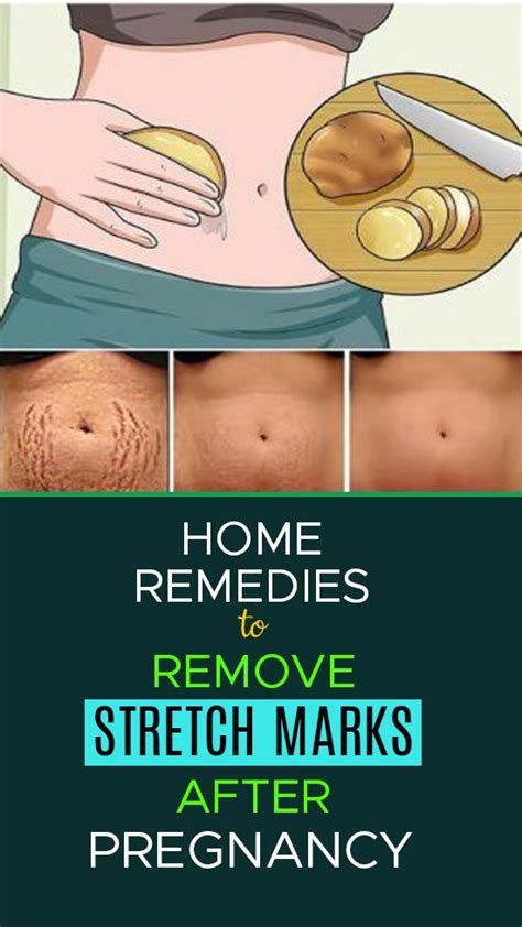 How To Remove Stretch Marks After Pregnancy 16 Home Remedies And Medical