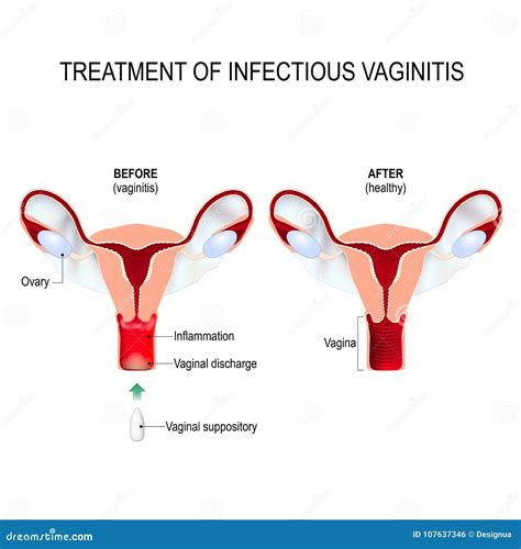 Inflammation Of The Vagina Vaginitis Infographics Vector Illustration On Background
