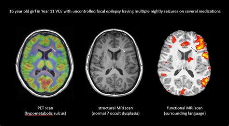 Epilepsy Brain Vs Normal Brain