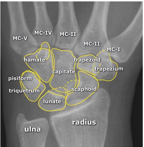 X Wrist Startradiology Radiology Student Radiology Medical Anatomy
