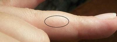 Burns may also cause blisters on the hands. Pin on ;-D