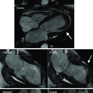 Diferentes patrones de realce tardío de la miocardiopatía hipertrófica