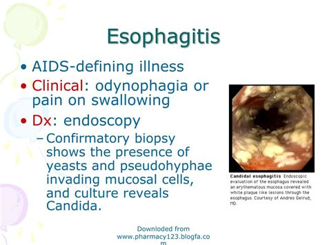 PPT Candidiasis PowerPoint Presentation Free Download ID