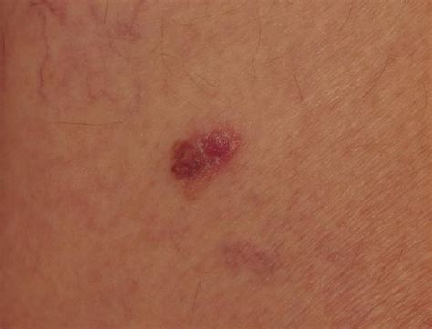 Nodular Melanoma Pictures Early Pictures Photos