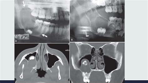 Radiographic Interpretation Of Cyst And Cyst Like Lesions Of The Jaws