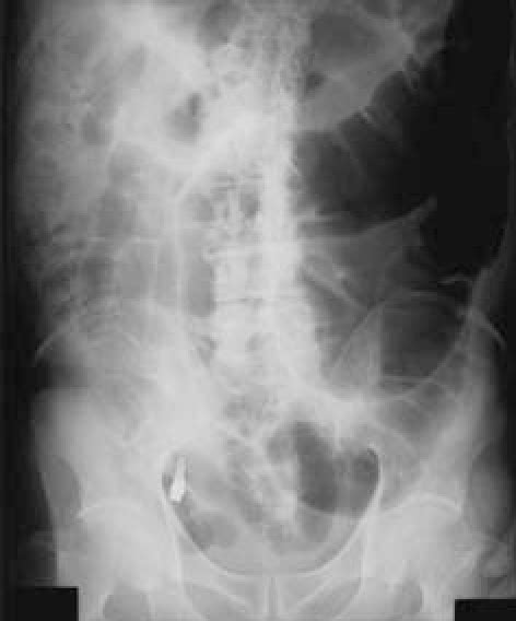 Figure 1 From Sigmoid Volvulus Showing A Whirl Sign On Ct Semantic