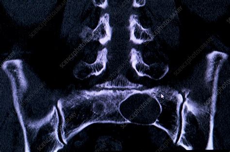 Tarlov Spinal Cyst Mri Scan Stock Image C0155994 Science Photo