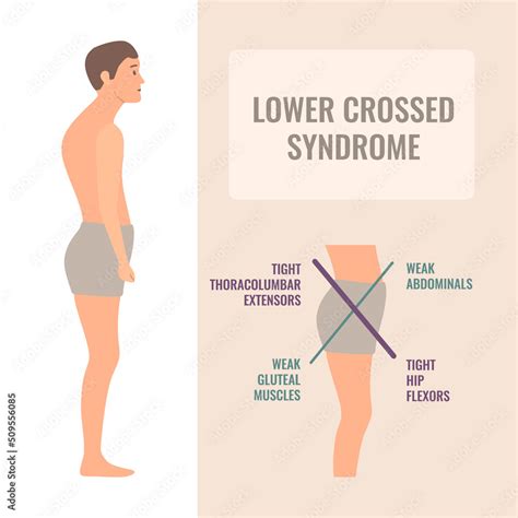 Lower Crossed Syndrome Medical Diagram Crooked Man With Muscle