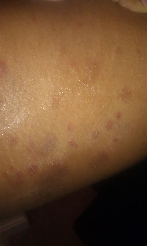 Have Had Rash For Several Weeks On Inner Thighs Top Of Feet