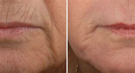 Lip Lines Smokers Lines Before And After Treatment With A Fractionated