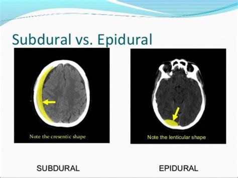 Diferencias entre hematoma subdural y epidural SOLUCIÓN