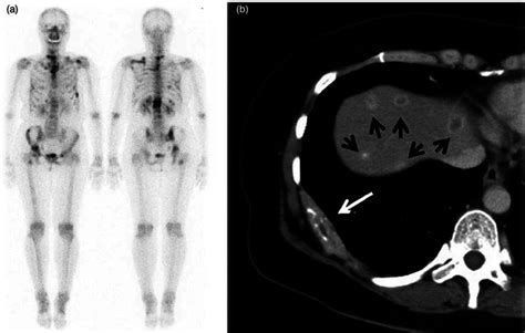 Bone Scan And Contrast Enhanced Ct Images At 5 Months After 89 Srcl 2
