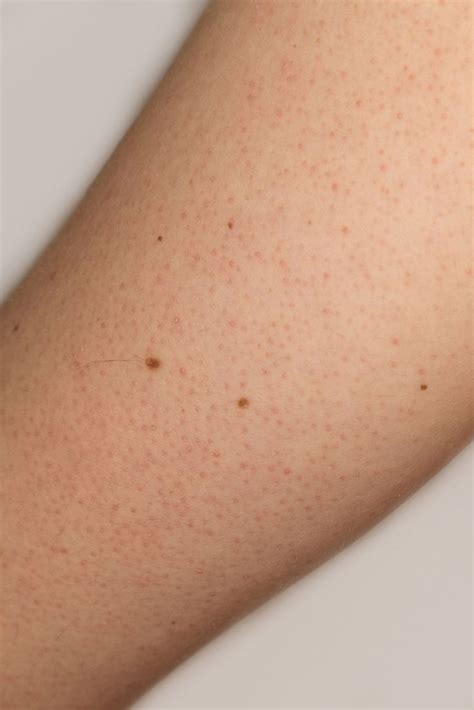 8 Common Skin Problems And How To Fix Them Black Dots On Skin Purple