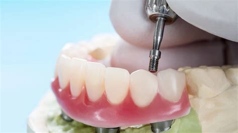 Are Dental Implants Safe Everything You Need To Know