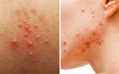 Fungal Acne Exists And You Might Have It Averr Aglow®