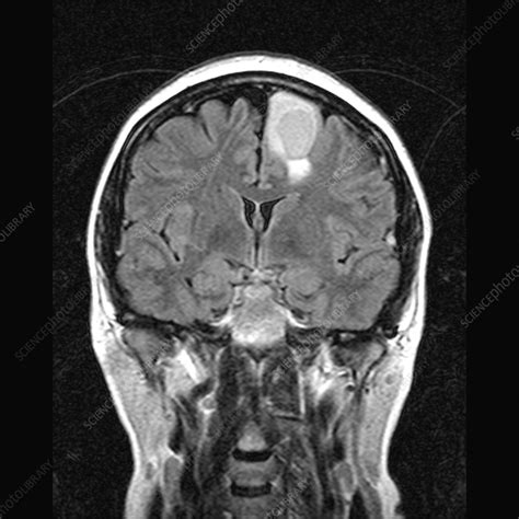 Brain Tumour Mri Scan Stock Image M1340804 Science Photo Library
