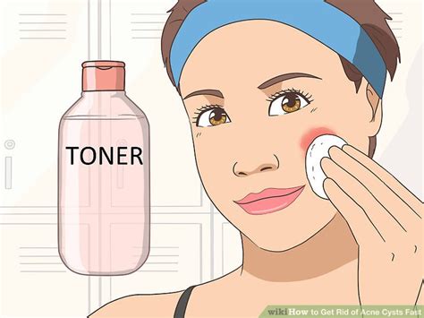 Ways To Get Rid Of Acne Cysts Fast Wikihow