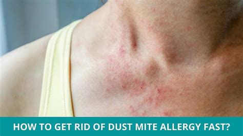 Understanding And Managing Dust Mite Allergy Symptoms Causes And