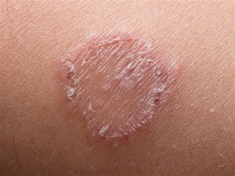 11 Effective Home Remedies For Ringworm Organic Facts