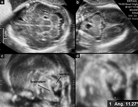 Open Fourth Ventricle Prior To 20 Weeks Gestation A Benign Finding
