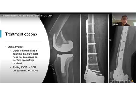 Pdf Periprosthetic Fractures Following Total Knee Arthroplasty My Xxx