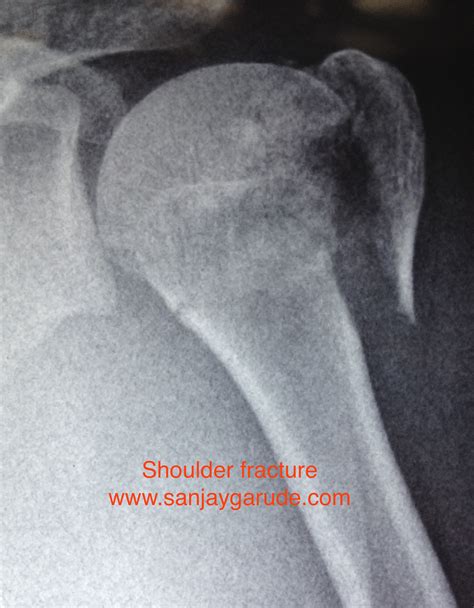 shoulder fractures dr sanjay garude