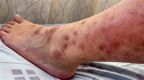 Muito Bem Sucedida Tempo De Vida Lagoa Dermatitis On Legs Sentimental