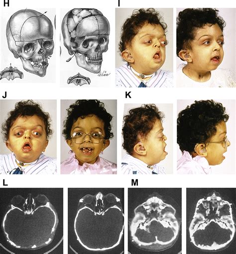 Craniofacial Dysostosis Syndromes Evaluation And Staged Reconstructive