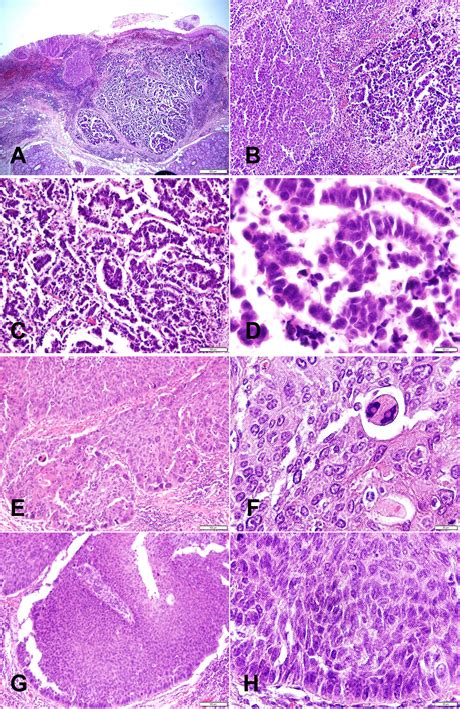 Primary Neuroendocrine Carcinoma Combined With Squamous Cell Carcinoma