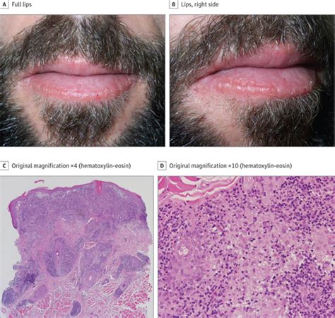 Persistent Nontender Lip Swelling In A Patient With Hiv Dermatology