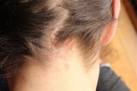Eczema Eczema Rash On Back Of Neck