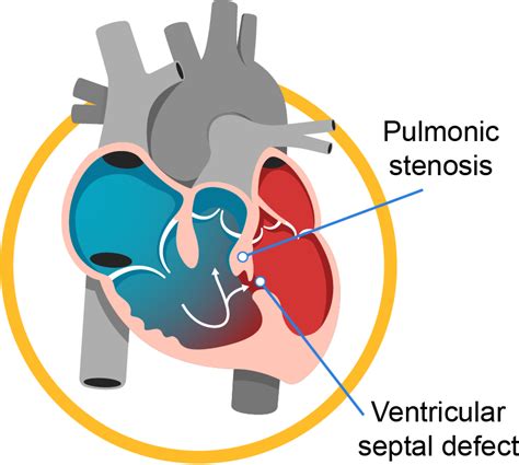 Congenital Heart Defects Chd A Complete Guide Gleneagles Hospitals