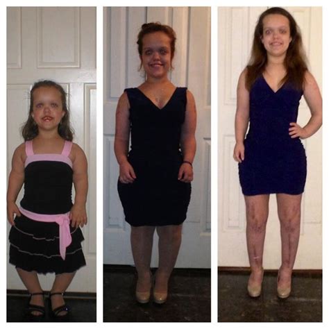 Pin On Before And After Limb Lengthening For Achondroplasia