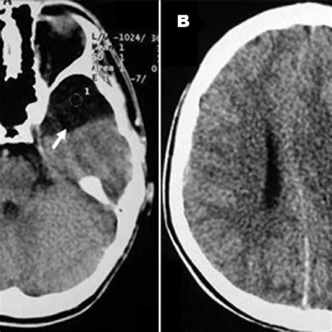 A Axial Ct Showing An Arachnoid Cyst In The Left Middle Cranial Fossa