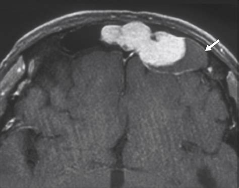 Solitary Fibrous Tumors Of The Head And Neck A Clinicopathologic And