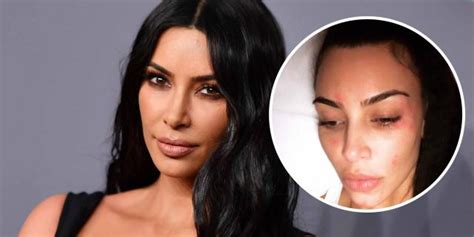 I Am The Only Kardashian With The Psoriasis Disease Kim Kardashian Infostride News