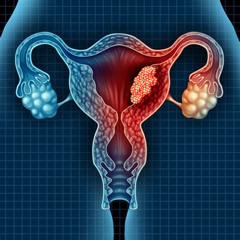 Endometrial And Cervical Cancer Insights Into Imaging
