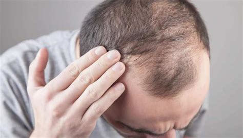 Alopecia Areata Hair Loss Causes Symptoms And Treatments