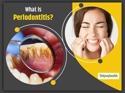 Know All About Periodontitis Symptoms Causes Treatment From