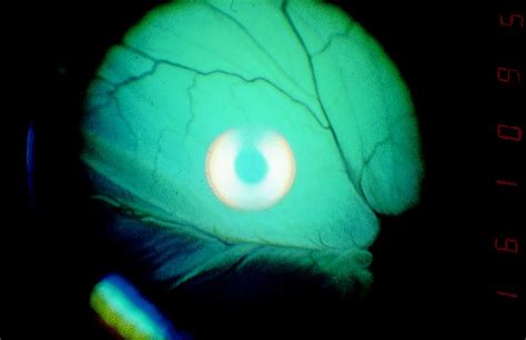 Complete Exudative Retinal Detachment From Choroiditis In The Left Eye